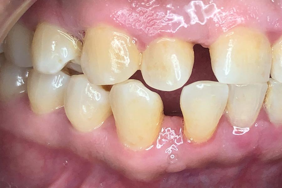 periodent-co-tijuana-dentist-dr-alejandra-gonzalez-before-after-periodontics-case-06-3
