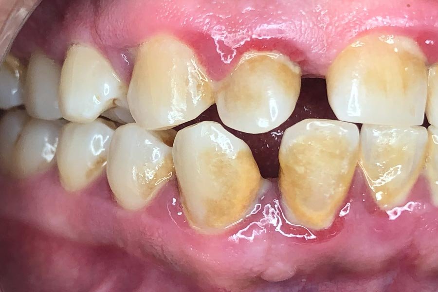 periodent-co-tijuana-dentist-dr-alejandra-gonzalez-before-after-periodontics-case-06-4 periodent-co-tijuana-dentist-dr-alejandra-gonzalez-before-after-periodontics-case-06-4