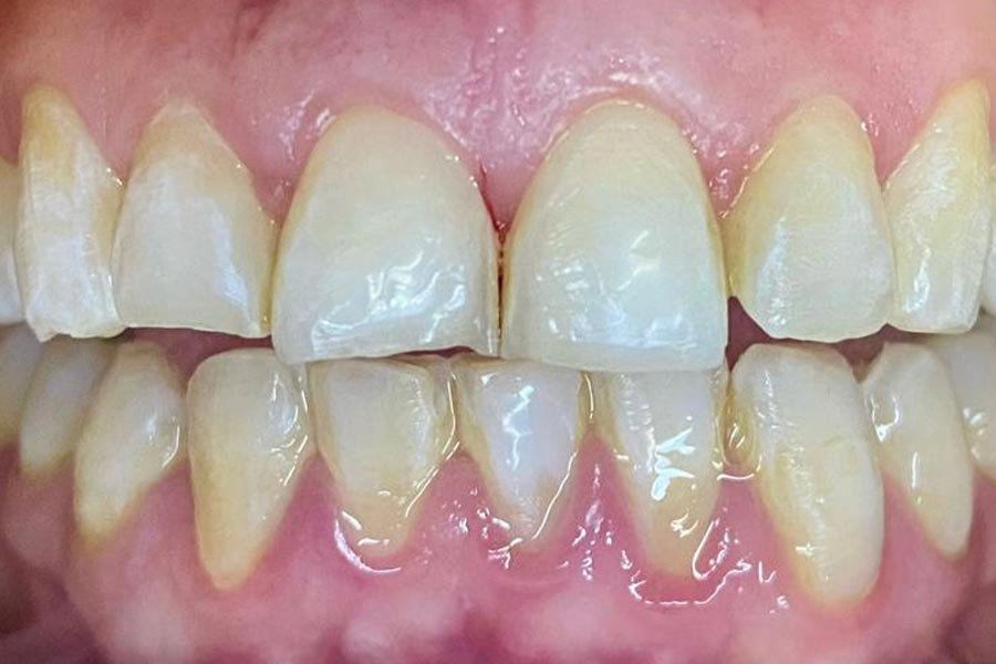 periodent-co-tijuana-dentist-dr-alejandra-gonzalez-before-after-periodontics-case-07-1