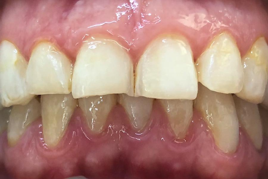 periodent-co-tijuana-dentist-dr-alejandra-gonzalez-before-after-periodontics-case-07-2 periodent-co-tijuana-dentist-dr-alejandra-gonzalez-before-after-periodontics-case-07-2