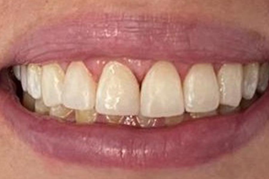 periodent-co-tijuana-dentist-dr-alejandra-gonzalez-before-after-periodontics-case-07-3