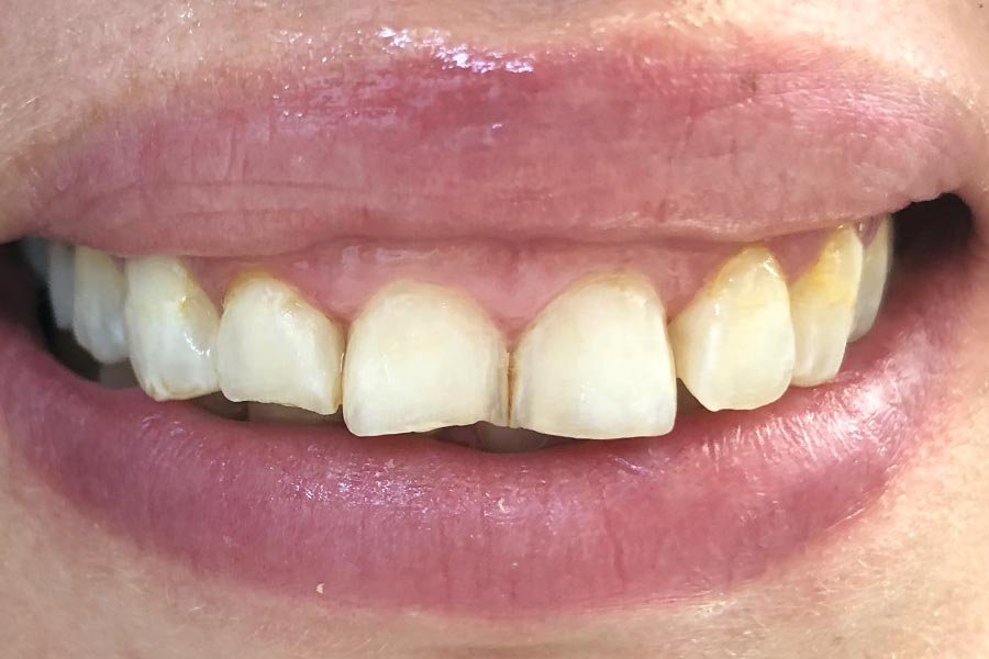 periodent-co-tijuana-dentist-dr-alejandra-gonzalez-before-after-periodontics-case-07-4 periodent-co-tijuana-dentist-dr-alejandra-gonzalez-before-after-periodontics-case-07-4