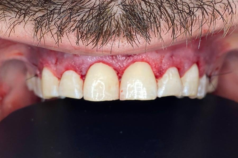 periodent-co-tijuana-dentist-dr-alejandra-gonzalez-before-after-periodontics-case-08-1
