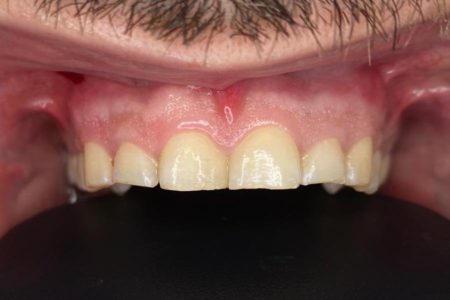 periodent-co-tijuana-dentist-dr-alejandra-gonzalez-before-after-periodontics-case-08-2 periodent-co-tijuana-dentist-dr-alejandra-gonzalez-before-after-periodontics-case-08-2