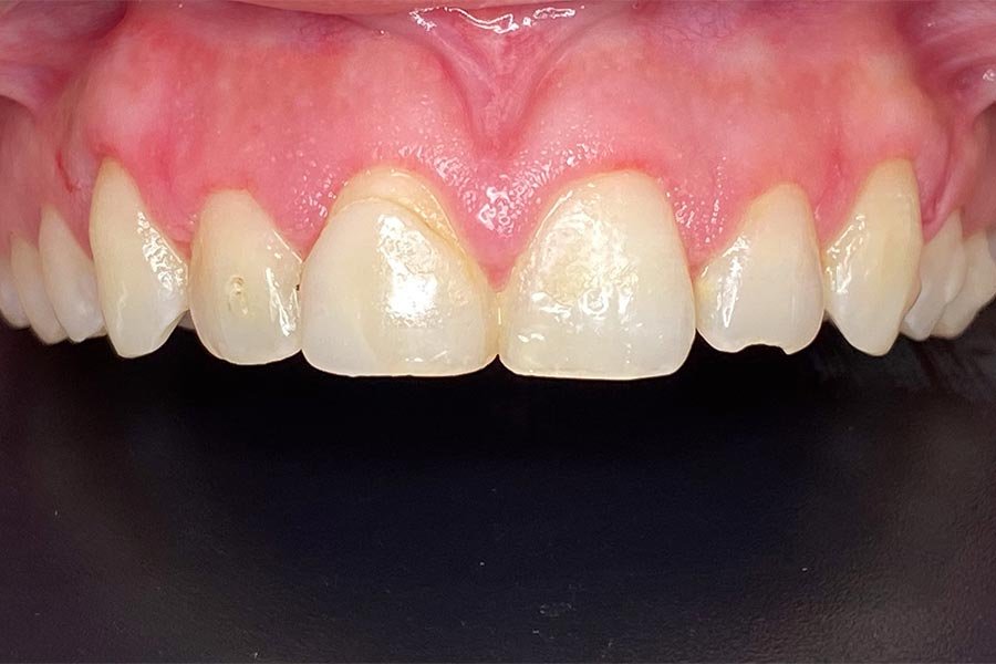 periodent-co-tijuana-dentist-dr-alejandra-gonzalez-before-after-periodontics-case-09-1