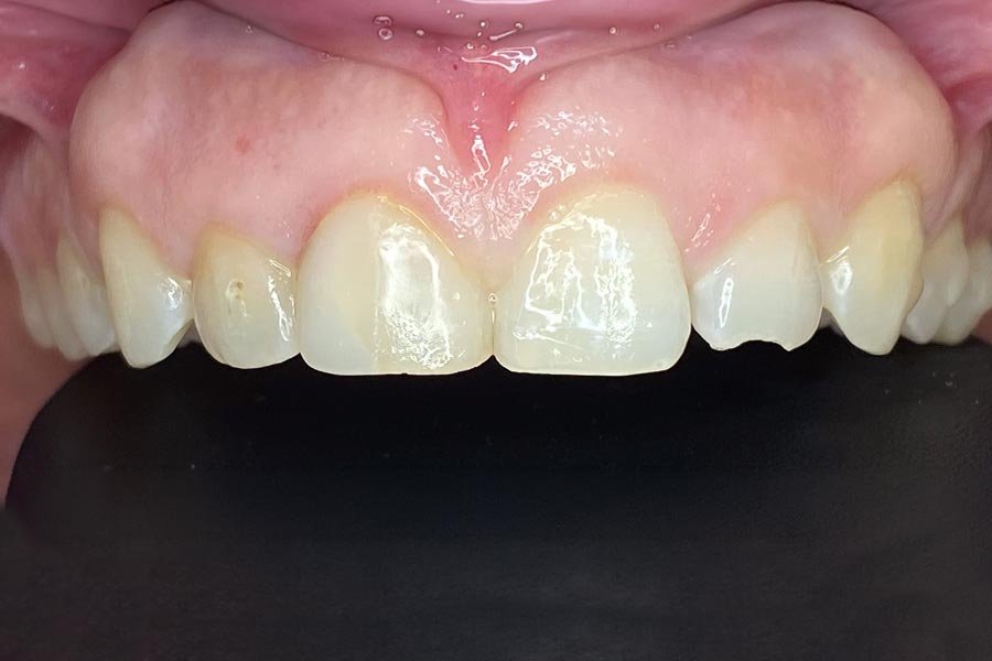 periodent-co-tijuana-dentist-dr-alejandra-gonzalez-before-after-periodontics-case-09-2 periodent-co-tijuana-dentist-dr-alejandra-gonzalez-before-after-periodontics-case-09-2